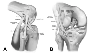 band of tissue connecting muscle and bone nyt