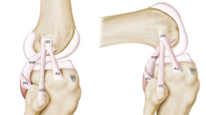 band of tissue connecting muscle and bone nyt